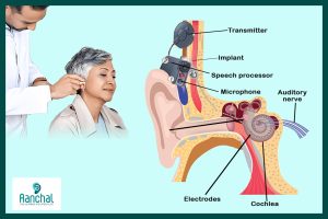 Improving Hearing for All Ages: The Impact of Cochlear Implants